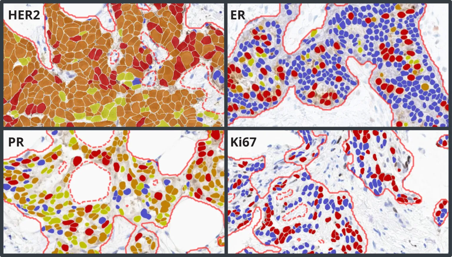 Breast-IHC-AI-v1.1-Feature-Image-1536x873.jpg
